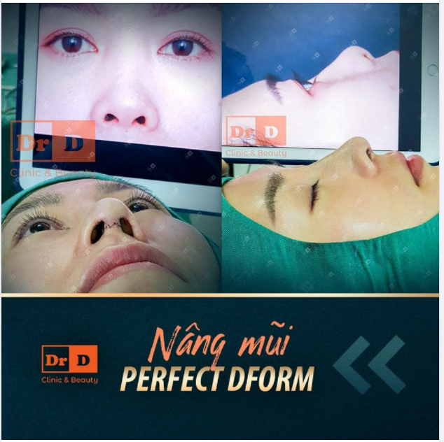 Nâng mũi Perfect Dform là kỹ thuật nâng mũi chỉ chỉnh sửa một phần cấu trúc mũi, thay vì toàn bộ.