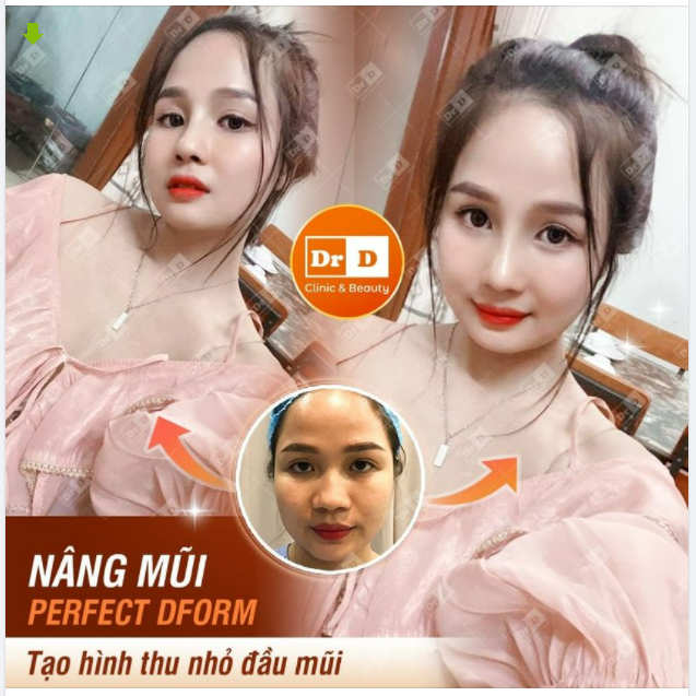 Nâng mũi Perfect Dform: Sang phần nhìn nhưng có ảnh hưởng đến chức năng mũi?