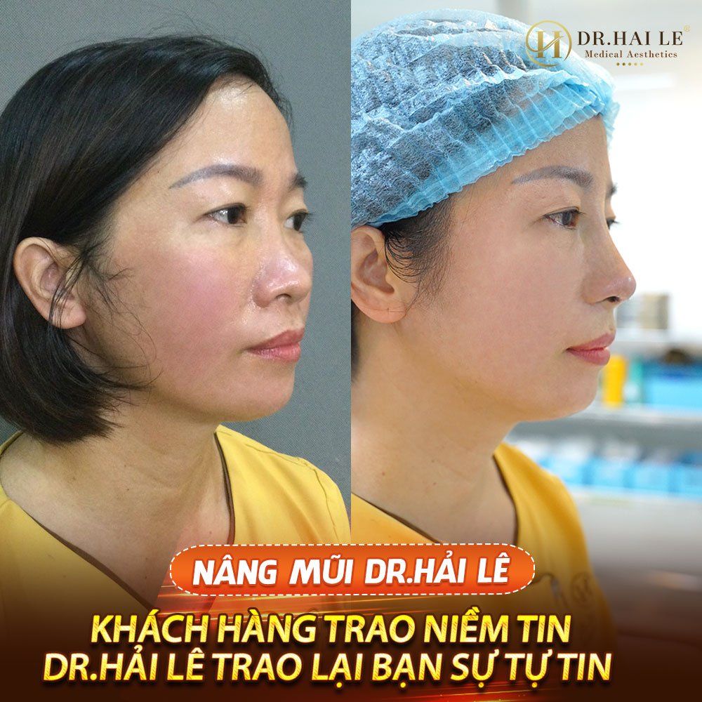 Nâng mũi thẩm mỹ - Bạn trao niềm tin Dr.Hải Lê sẽ trao lại cho bạn sự tự tin.!