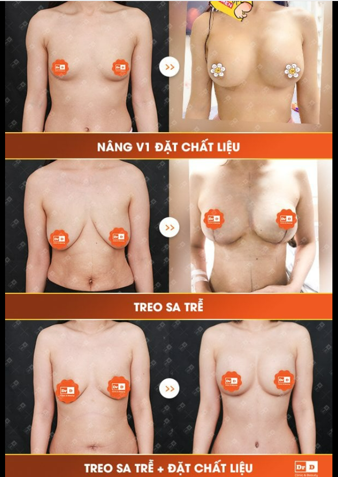 Nâng ngực đặt túi độn khác gì so với treo sa trễ - Dịch vụ nào "nhẹ nhàng" hơn?