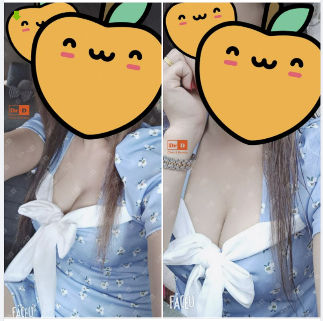 Nâng ngực sau 2 tháng, nàng nào cũng bảo chắc phải thay cả tủ đồ mới vì đồ chật hết rồi.