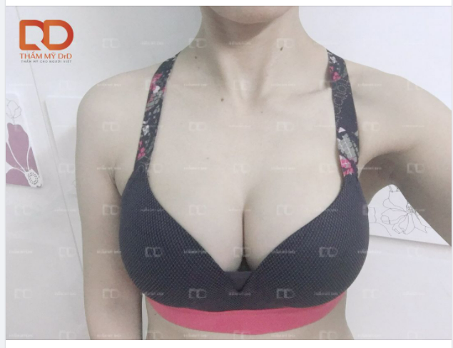 Nâng ngực sau khoảng 1 tháng có thể vận động nhẹ nhàng, còn tập luyện cường độ mạnh các nàng nên chờ khoảng 3 tháng nhé.