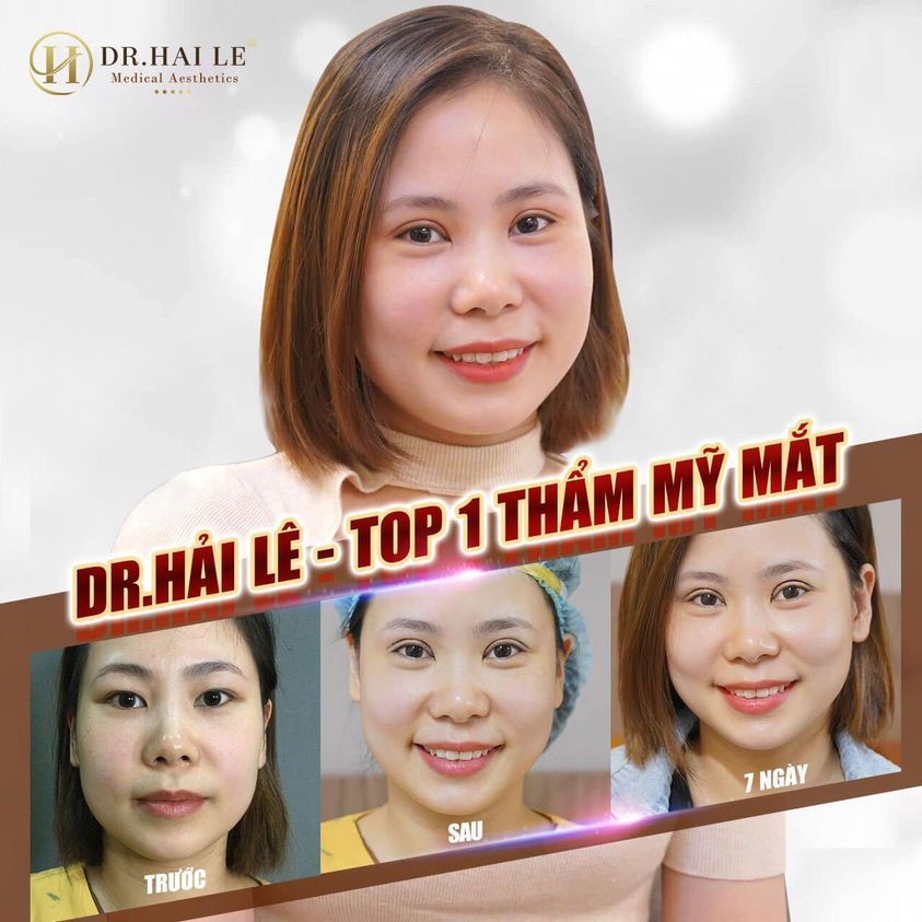 NÀNG THƠ Có ai mê mẩn nếp mí này không ạ? Comment cho Dr.Hải Lê được biết nhé.!