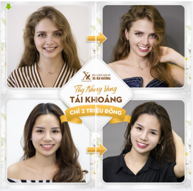 NÂNG TONE MÀU RĂNG TRẮNG SÁNG - TỰ TIN CƯỜI XINH NHỜ TẨY TRẮNG RĂNG TÁI KHOÁNG FLASH WHITENING
