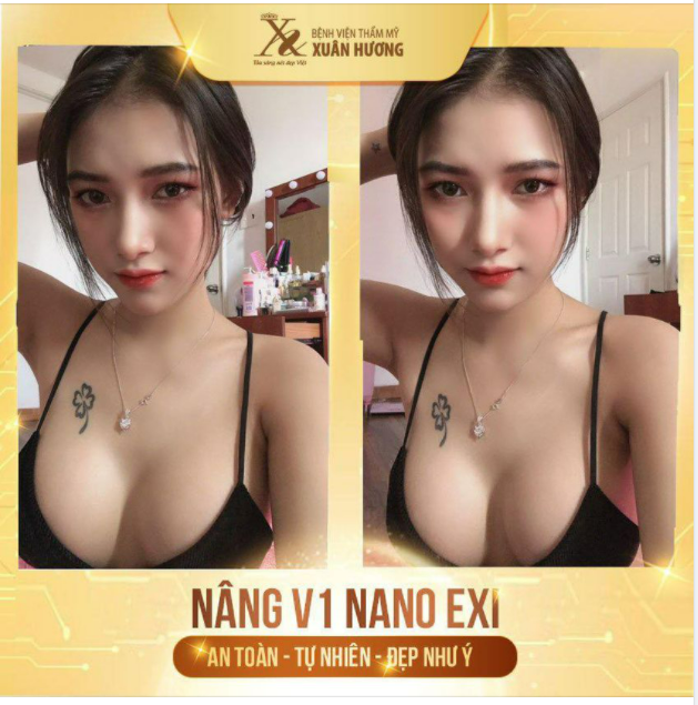 "NÂNG V1 LÀ QUYẾT ĐỊNH LÀM ĐẸP ĐÚNG ĐẮN NHẤT CỦA MÌNH TỪ TRƯỚC ĐẾN GIỜ"