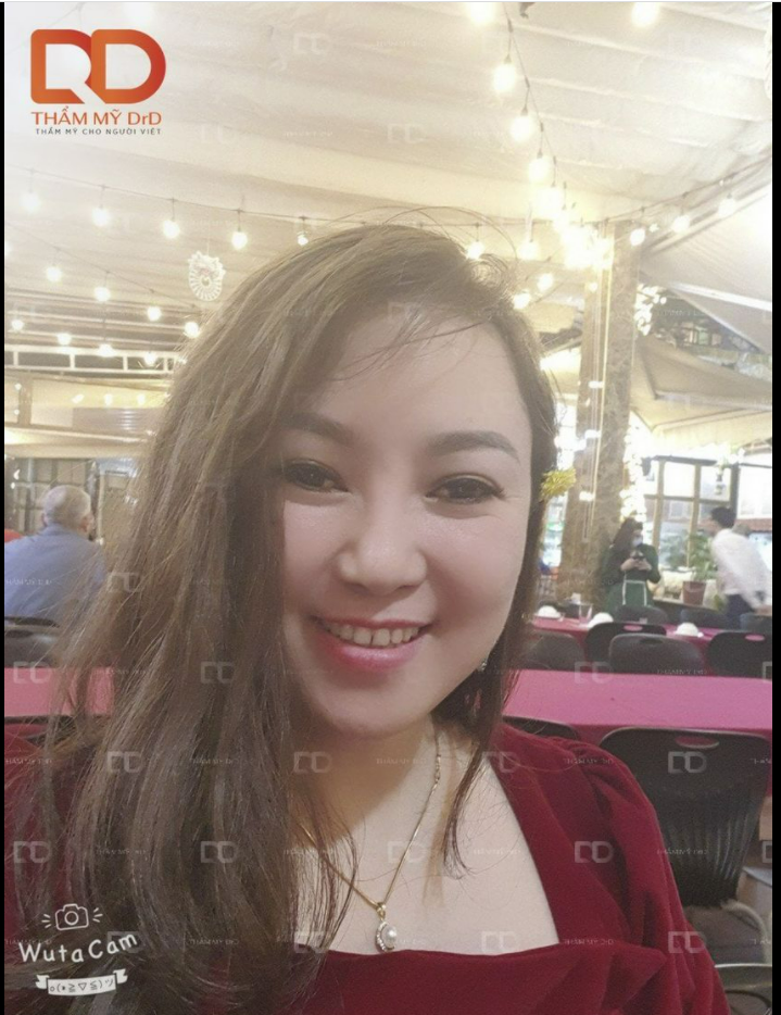 Nay thời tiết Hà Nội mát mẻ, bác sĩ xin phép khoe "nhẹ" một chiếc feedback Cắt mí Elite Eyes mà khách hàng rất rất ưng ý.