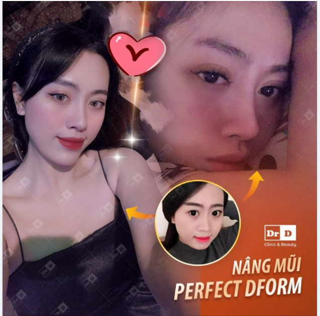 Nên nâng mũi hay không nâng mũi? Nên thực hiện phẫu thuật hay tiêm filler?