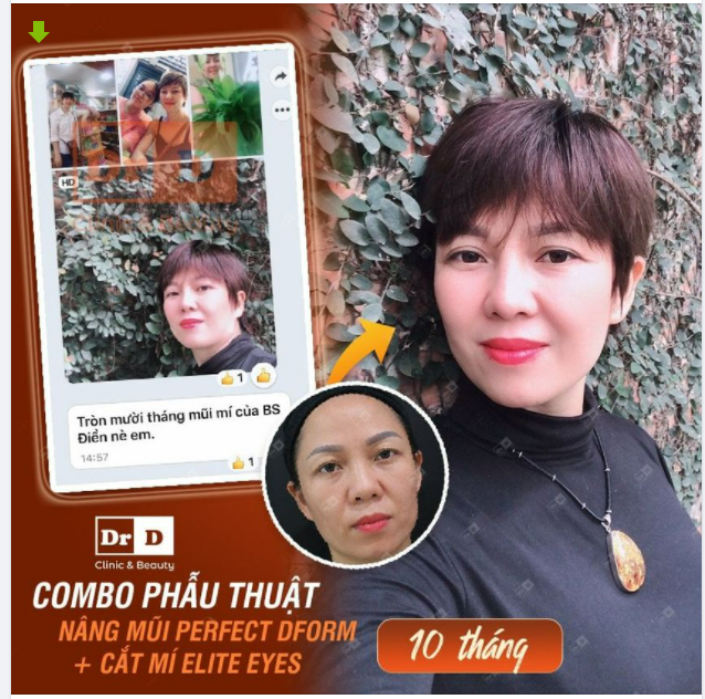 Nét như SONY nhờ combo mũi mí là có thật. Nhưng khi nhắc đến combo thì nàng lại "ái ngại" trước các nỗi lo sợ.