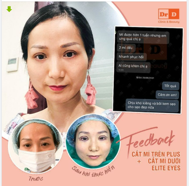 Ngày đầu tuần mát mẻ, up "sương sương" 1 chiếc feedback Combo cắt mí tại DrD