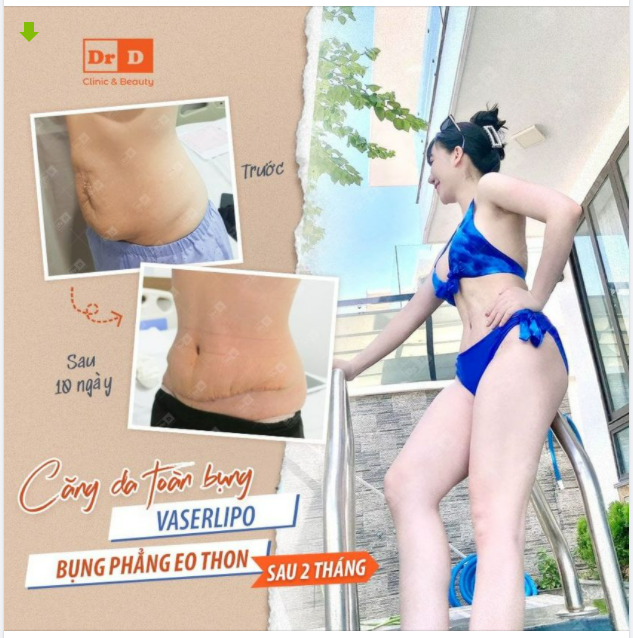 Gửi chiếc Feedback Hút mỡ bụng VASERlipo chào buổi sáng các chị em.