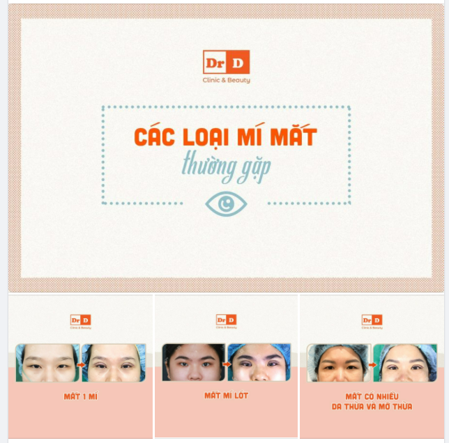 Những kiểu mí đặc trưng mà Bác sĩ PTTM thường gặp nhất?