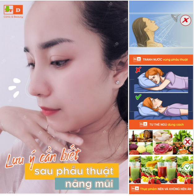 Những lưu ý cần biết sau phẫu thuật nâng mũi