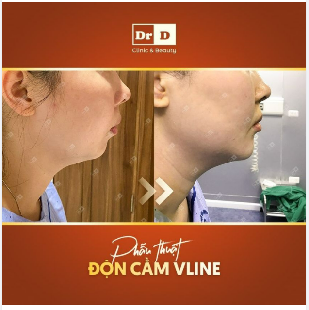 Những lưu ý trước khi thực hiện Độn cằm Vline