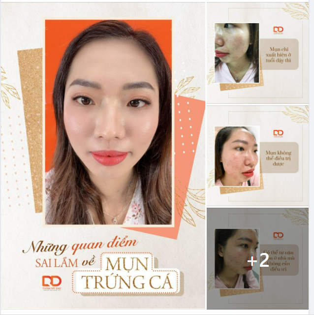 Những quan điểm sai lầm về mụn trứng cá
