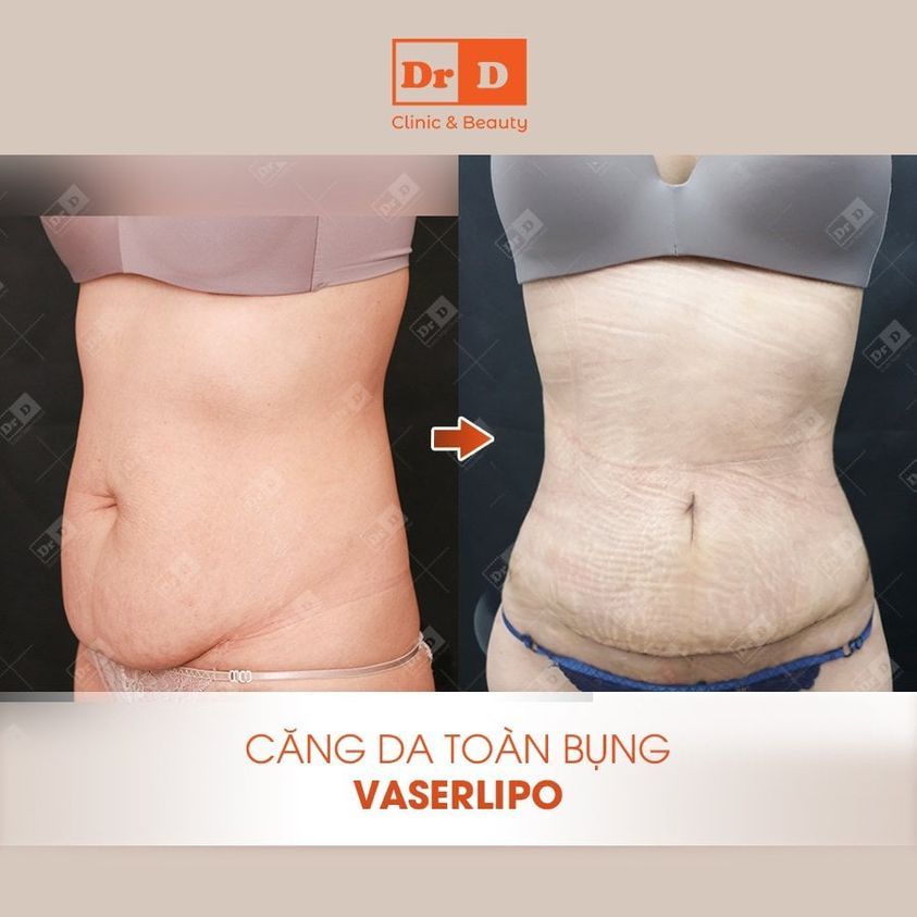 Những vết hằn trên bụng các nàng đang thấy là do tác động của gen nịt bụng chứ không phải da bị nhăn nheo sau phẫu thuật đâu nhé.