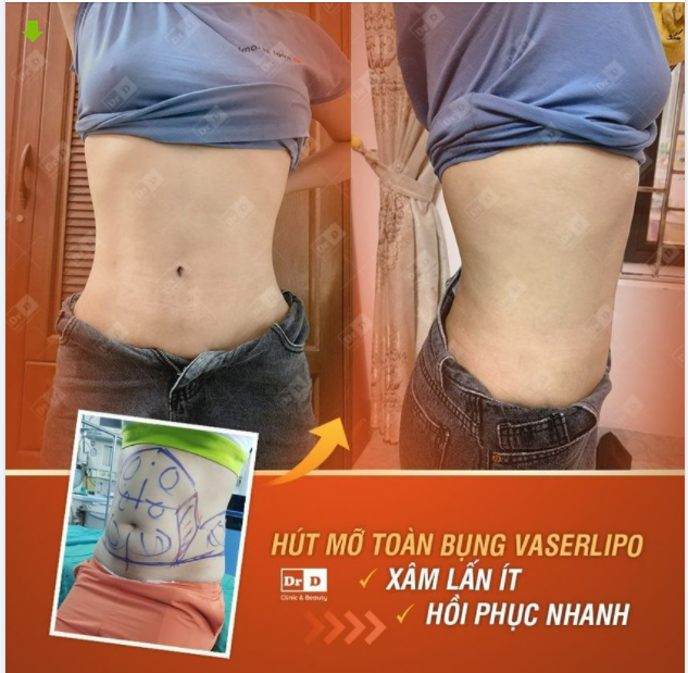 Ở đây có một sự eo thon không hề nhẹ. Không quá ngạc nhiên khi CÔNG NGHỆ HÚT MỠ VASERLIPO hoàn toàn "ăn đứt" những bữa ăn kiêng kém hiệu quả.