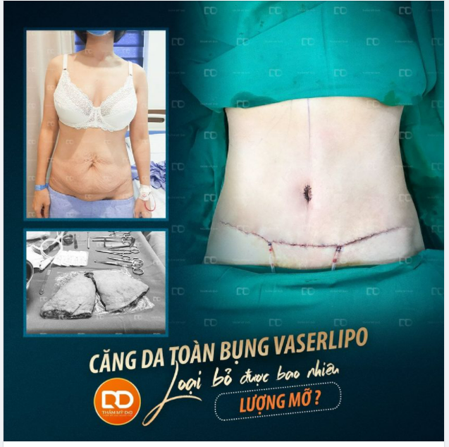 Phẫu thuật căng da bụng Vaserlipo loại bỏ được bao nhiêu lượng mỡ thừa?