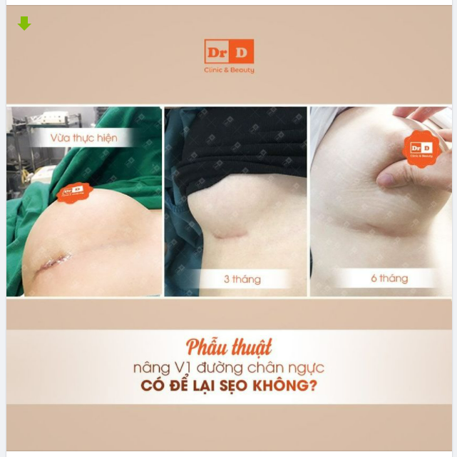 Phẫu thuật đường chân ngực có để lại sẹo không?