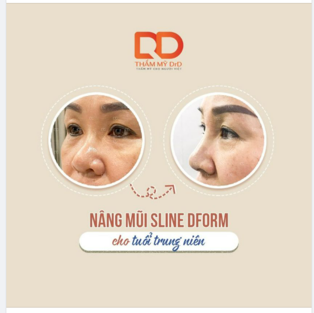 Phẫu thuật nâng mũi ở tuổi trung niên? Tại sao không?