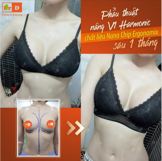 Phẫu thuật Nâng V1 Harmonic: Được nhiều nhưng liệu có bị mất đi cảm giác?