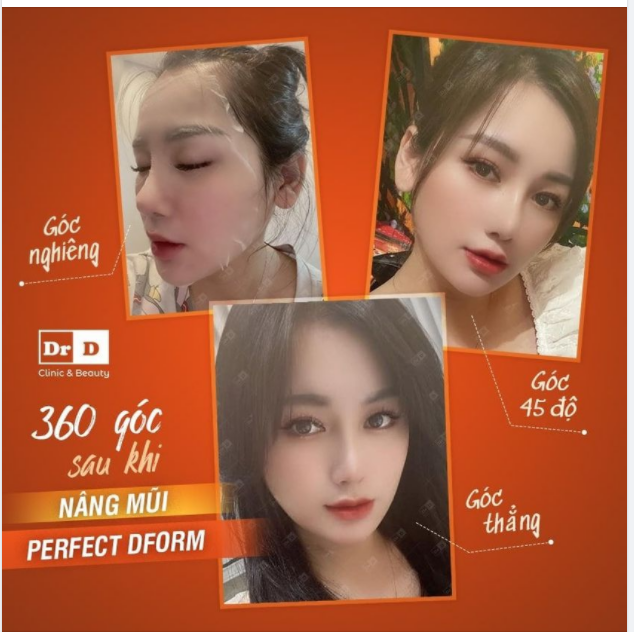 Sau khi Nâng mũi Perfect Dform các góc nhìn sẽ như thế nào?