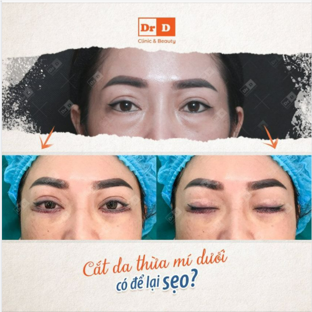 Sẹo luôn là vấn đề được quan tâm khi thực hiện Cắt mí dưới.