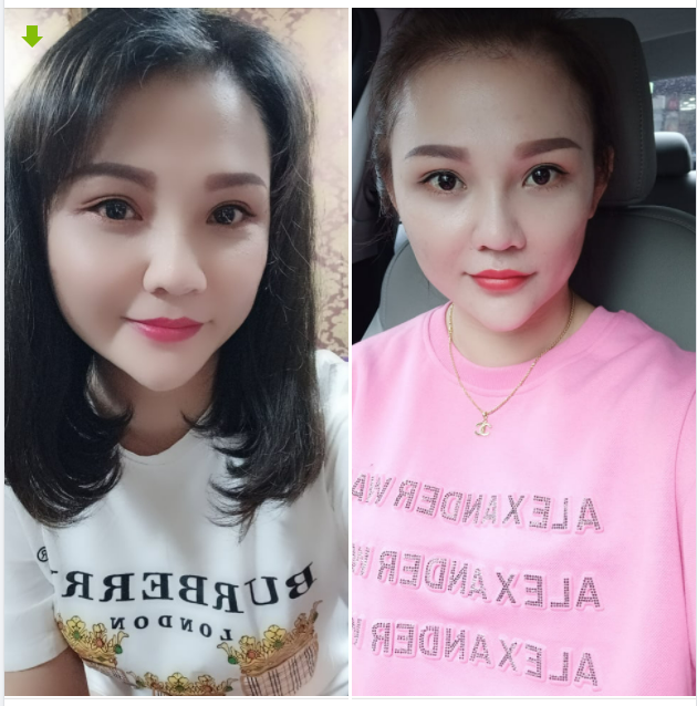 Series feedback cho combo Nâng mũi Cắt mí vẫn chưa dừng lại.