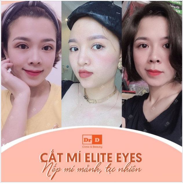 Sông có thể cạn, núi có thể mòn nhưng với cắt mí Elite Eyes sẽ tồn tại trọn đời.