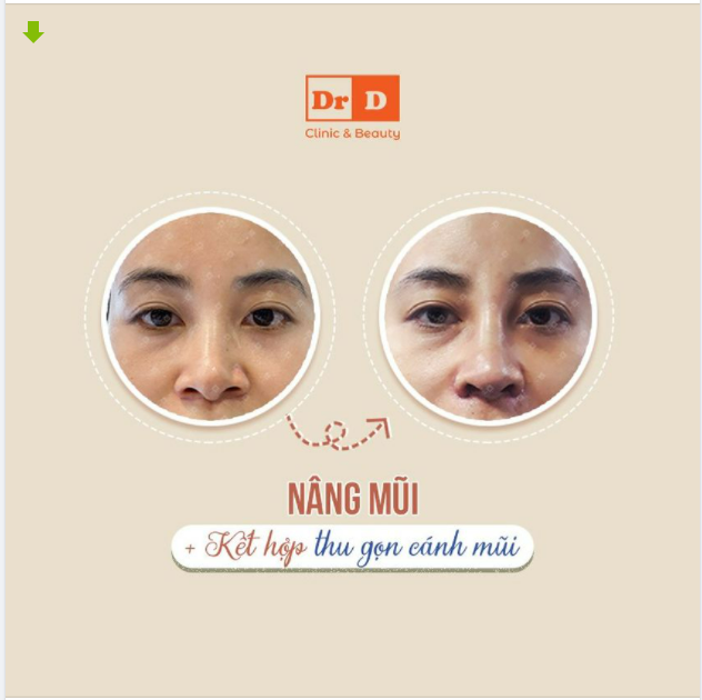 Sống mũi cao thanh tú nhưng cánh mũi lại bè rộng sẽ làm tỷ lệ khuôn mặt kém duyên, không hài hòa.