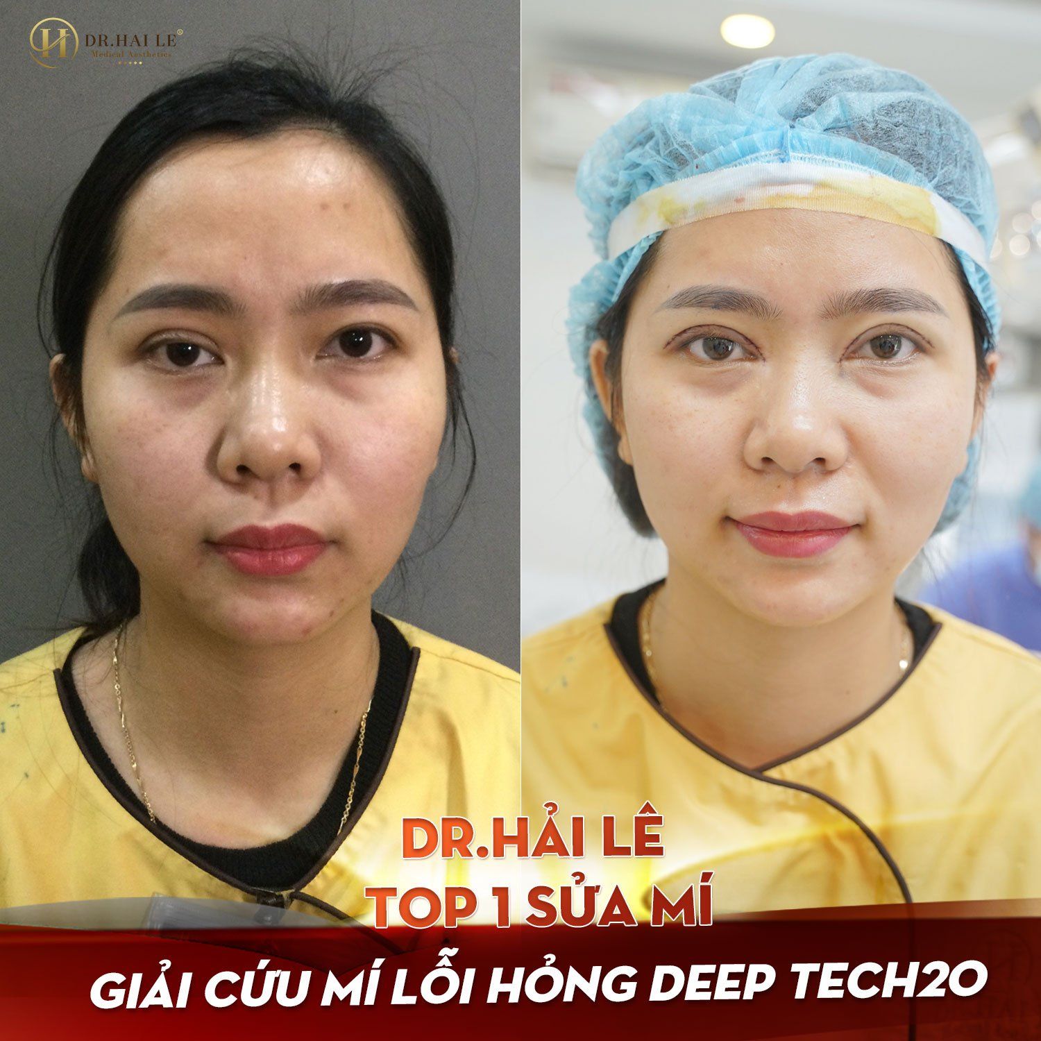 SỬA MÍ DEEP TECH20 - BẠN TRAO NIỀM TIN, DR.HẢI LÊ TRAO BẠN SỰ TỰ TIN.!!