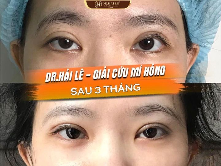 SỬA MÍ DEEP TECH20 - DR.HẢI LÊ CAM KẾT LUÔN LÀM KHÁCH HÀNG HÀI LÒNG.!!