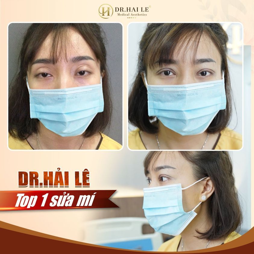 SỬA MÍ “XẤU, HỎNG” DEEP TECH20 - DR.HẢI LÊ LÀ ĐỊA CHỈ TOP 1
