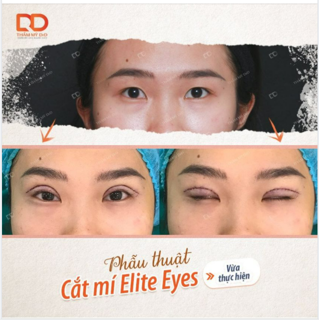 Tại sao DV Cắt mí tại DrD lại có tên là Elite Eyes?