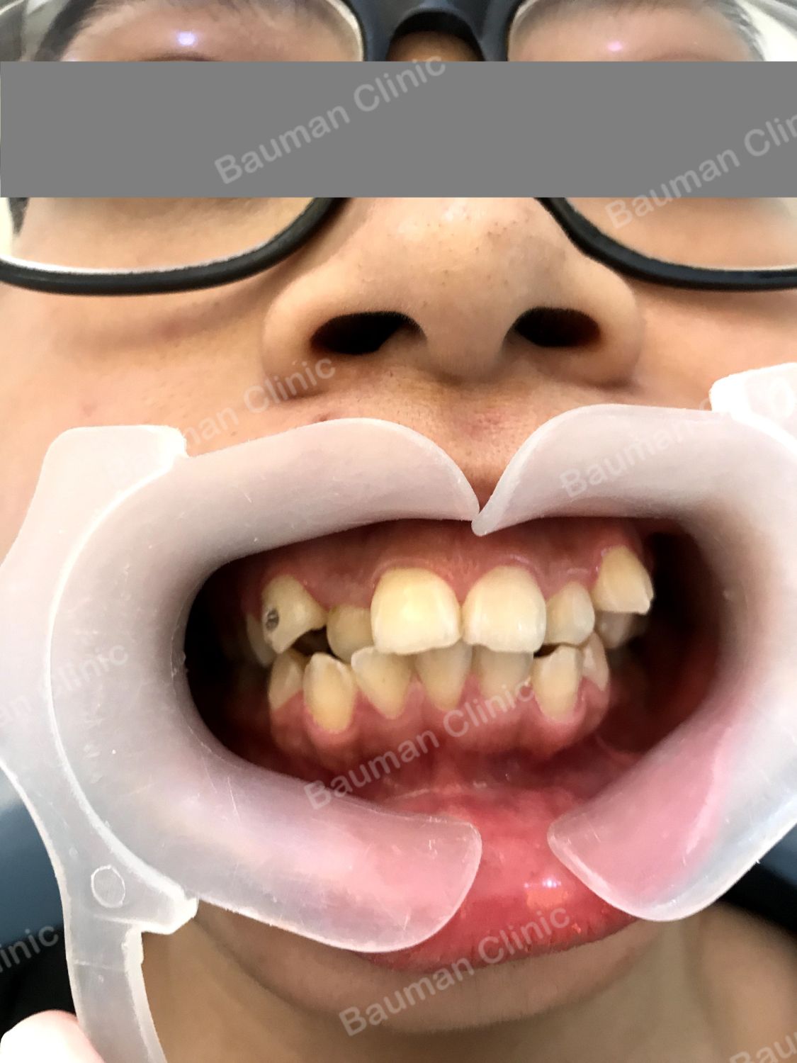 Ca niềng răng số 5013 - Nha khoa Bauman Clinic