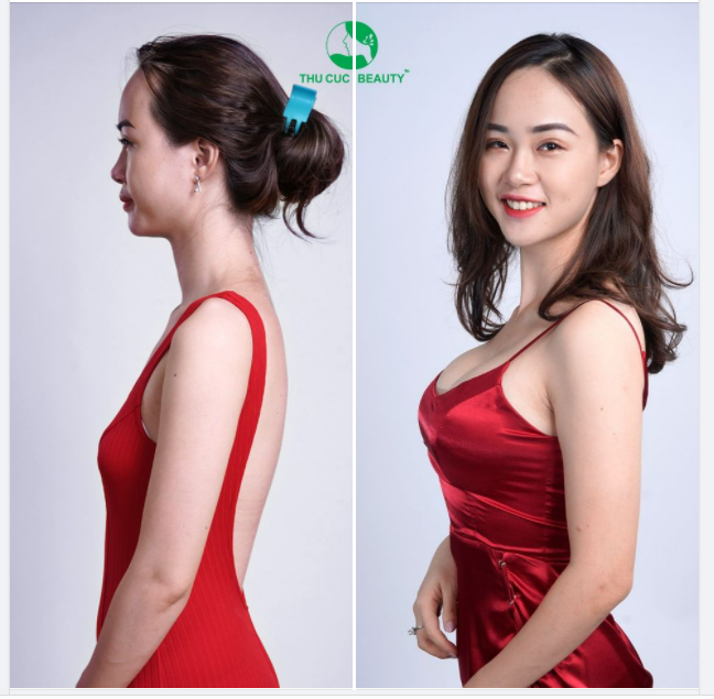 THẨM MỸ V1 - BÍ QUYẾT BIẾN "HAI LƯNG" THÀNH "ĐỒI NÚI" CHẬP CHÙNG