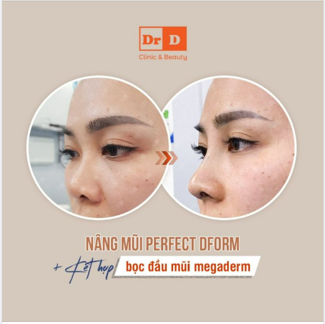 Thông thường, dáng mũi Perfect Dform đã được bao bọc bởi nhiều lớp chất liệu tự thân nên sẽ không sợ việc bị bóng bỏ đầu mũi.