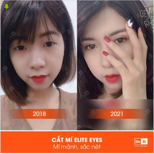 Top những phương pháp cắt mí không những đẹp mà còn an toàn