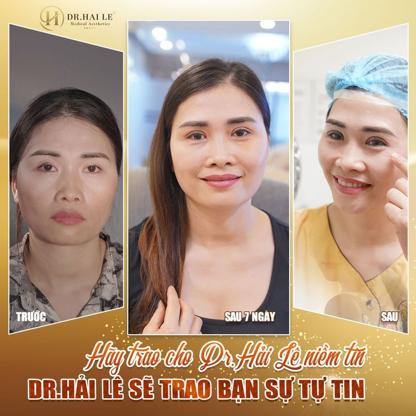 Trầm cảm suốt gần 3 năm khi phải sống chung với đôi mắt lỗi hỏng
