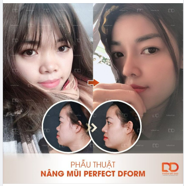 Từ ngày Hà Nội giãn cách, dù không tư vấn trực tiếp tại cơ sở hay thực hiện phẫu thuật thì DrD vẫn tư vấn online các nàng nhé.
