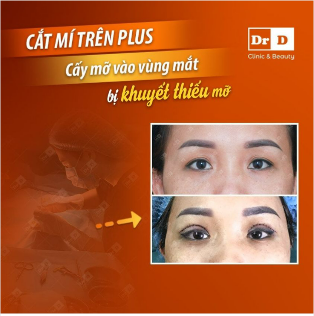 Với tình trạng: "Hốc mắt sâu, khuyết thiếu mỡ" chỉ cắt mí đơn thuần thì có khắc phục được không?