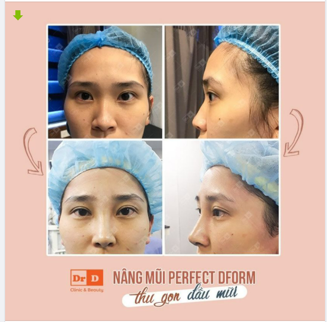 Xấu ở đâu sửa ở chỗ đó - Mũi tet, đầu mũi to thô hãy nghĩ ngay đến Nâng mũi Perfect Dform