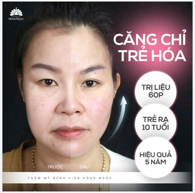 1 LẦN CĂNG CHỈ: TRẺ RA 10 TUỔI - ĐẸP SUỐT 5 NĂM.