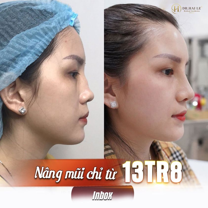 SỬA MŨI GỒ - BẠN TRAO NIỀM TIN, DR.HẢI LÊ TRAO LẠI BẠN SỰ TỰ TIN.!