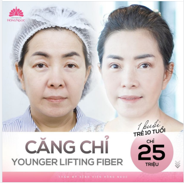 60P ''LÀ PHẲNG'' NẾP NHĂN - TRẺ HÓA THẦN TỐC VỚI CĂNG CHỈ YOUNGER LIFTING FIBER