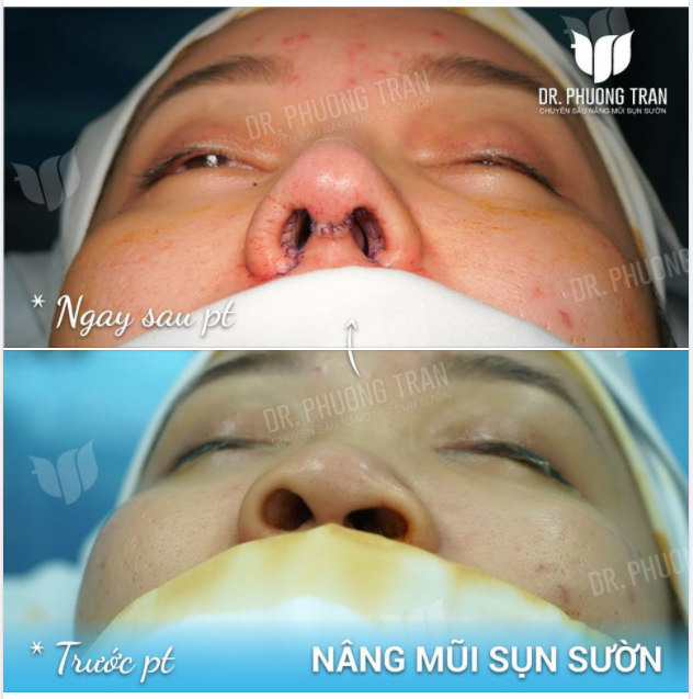 BẠN ẤY BỊ VẸO VÁCH NGĂN BẨM SINH