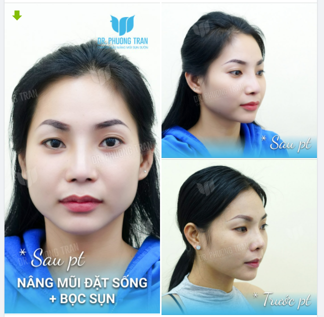BẠN ẤY TỪ CAMPUCHIA SANG CHỈ ĐỂ…SỬA MŨI LẦN 3
