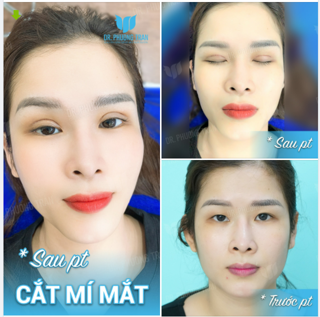 Bạn có biết cắt mí cần sự tập trung và tỉ mỉ hơn cả nâng mũi?
