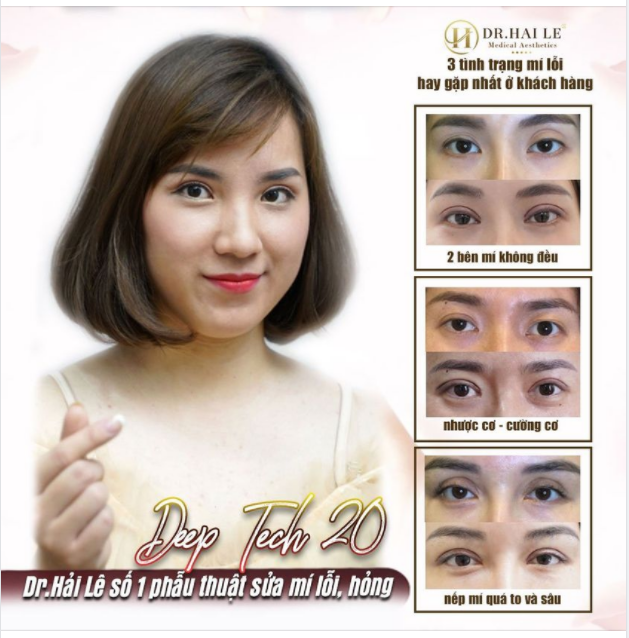 BẠN ĐƯỢC GÌ KHI SỬA MÍ TẠI DR.HẢI LÊ ?