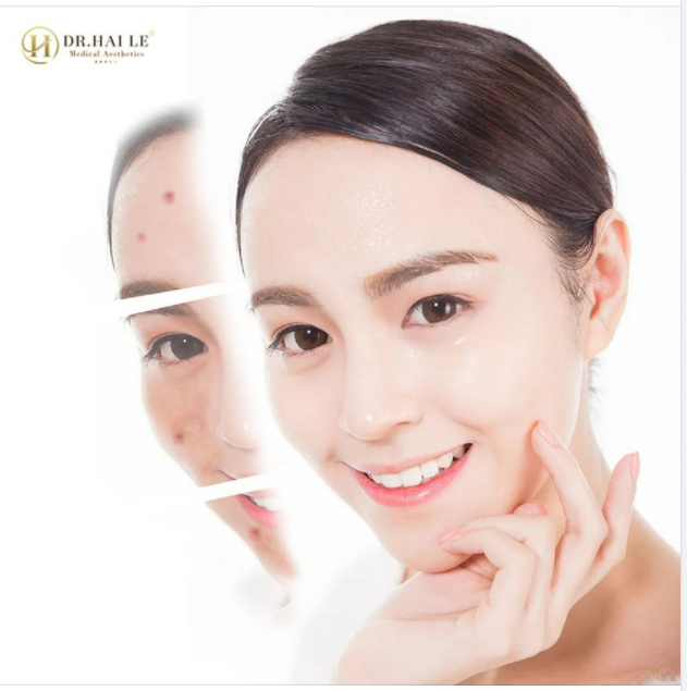 BẠN GÁI TÔI MẶT MỤN......