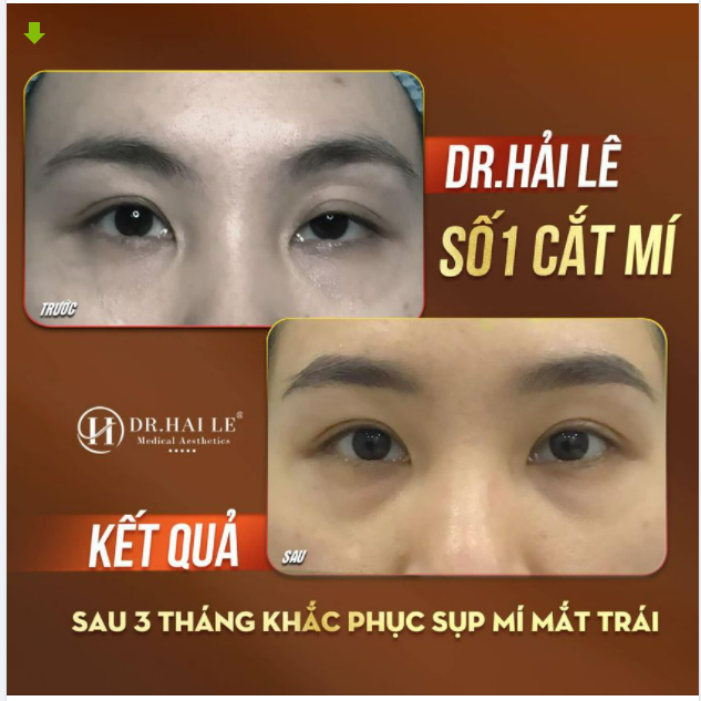 BỆNH LÝ NHƯỢC CƠ NÂNG MI BẨM SINH NGUY HIỂM CỠ NÀO!